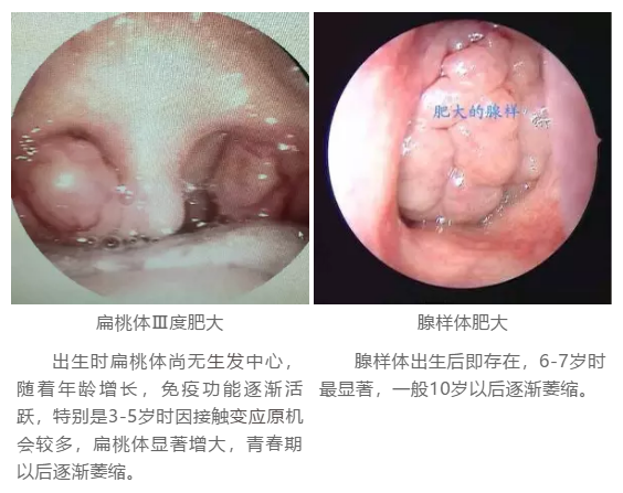 扁桃体肥大