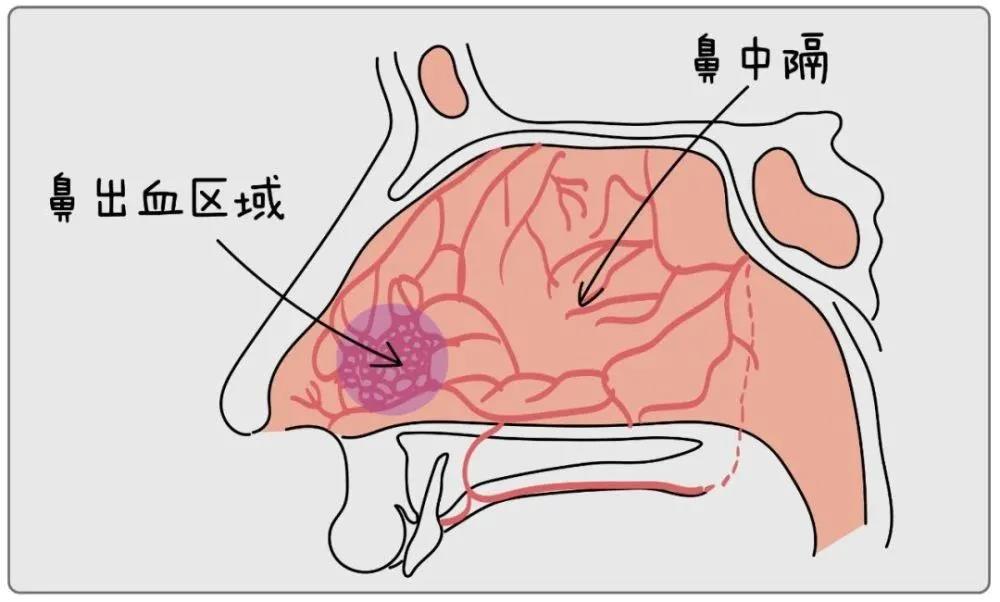 鼻出血