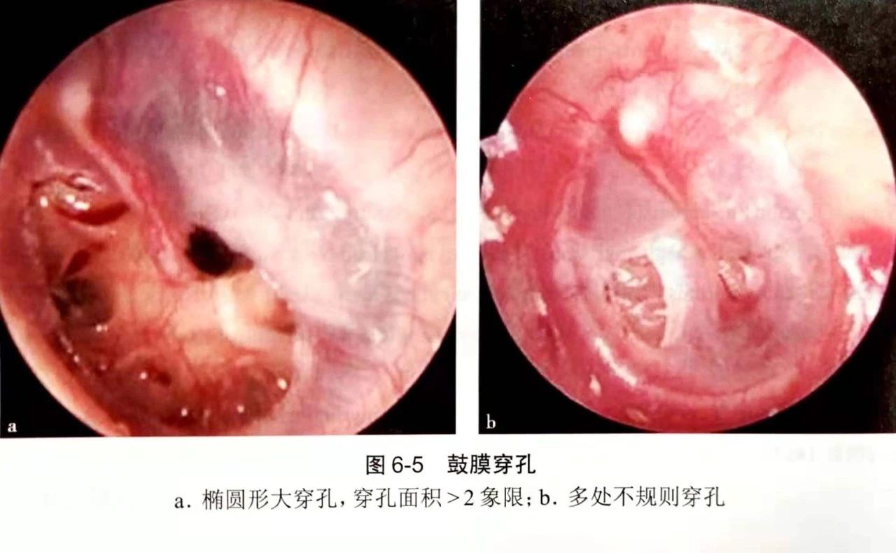 鼓膜穿孔