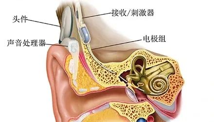 人工耳蜗